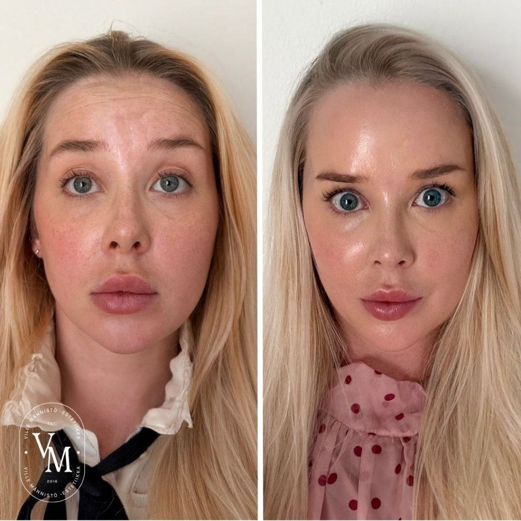 full face botox ville mannisto